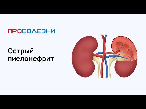 Видео: Острый пиелонефрит