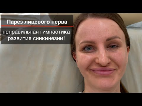 Видео: Парез лицевого нерва, неправильная гимнастика, развитие синкинезии!