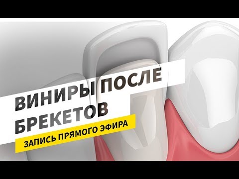 Видео: Виниры после брекетов.