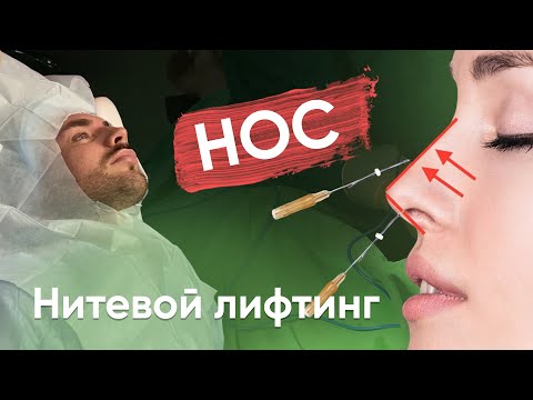 Видео: НИТИ В НОС  - одна из самых популярных на сегодня процедур в косметологии.