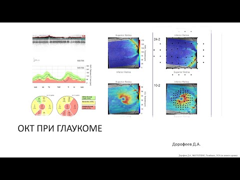 Видео: Основы ОКТ при глаукоме 1/7