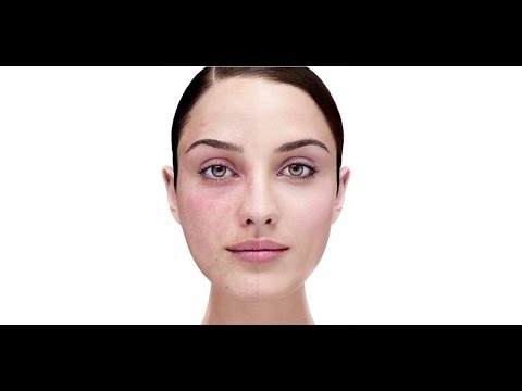 Видео: Крем от купероза на эмульгаторе Neocare