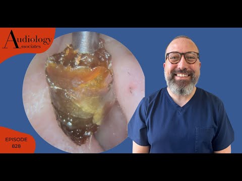 Видео: СУХАЯ КАК КОСТЬ УШНАЯ СЕРА И НЕ ТОЛЬКО УДАЛЕНИЕ УШНОЙ СЕРЫ -EP828