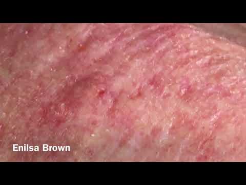 Видео: Солнечные комедоны у мотоциклиста, часть 4