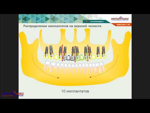 Видео: 2017 04 25  Протезирование на имплантатах  обсуждение клинических примеров