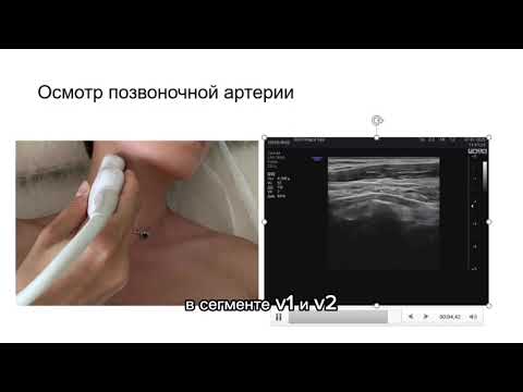 Видео: Методика УЗДС сосудов шеи