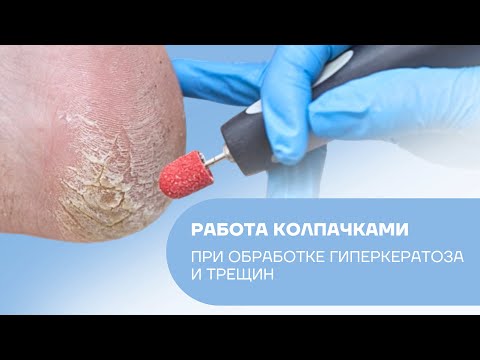 Видео: Как работать колпачками при обработке гиперкератоза и трещин?