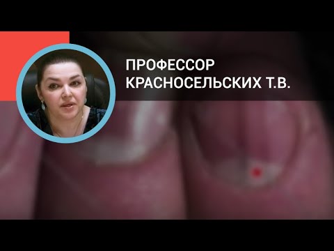 Видео: Профессор Красносельских Т.В.: Болезни ногтей