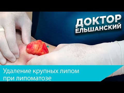 Видео: Удаление крупных липом при липоматозе Removal of lipomas in multiple lipomas (lipomatosis)