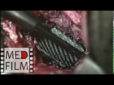 Видео: Замещение шейных позвонков © Replacement of the cervical vertebrae