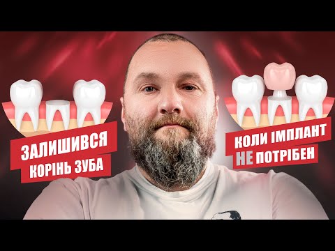 Видео: 🇺🇦 Остался корень зуба, что делать?