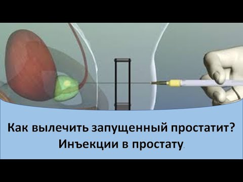 Видео: Лечение простатита.  Инъекции в простату