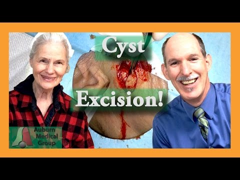 Видео: Лицо атерома Удаление | Auburn Medical Group