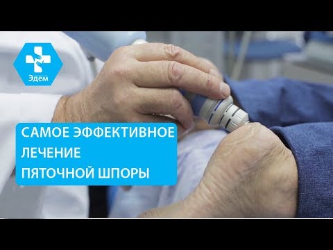 Видео: 👣 Как лечить пяточную шпору методом ударно волновой терапии. Пяточная шпора как лечить. ЭДЕМ. 12+