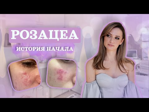 Видео: РОЗАЦЕА. МОЯ ИСТОРИЯ. ЧАСТЬ 1