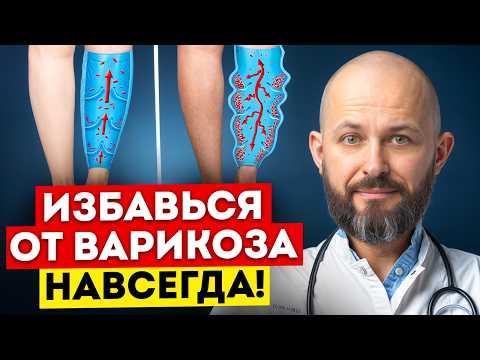 Видео: Симптомы варикоза и его последствия / Как лечить варикоз вен в домашних условиях?