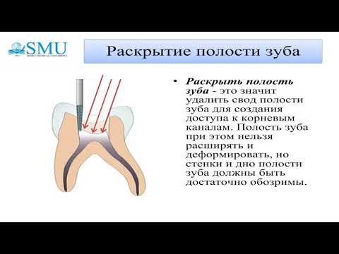 Видео: Методы лечения пульпитов