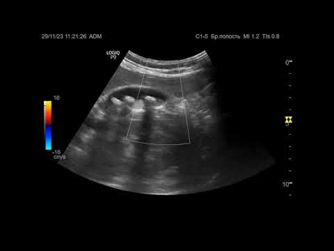 Видео: Ультразвуковая диагностика. Доктор Иогансен. Видеопримеры. Выпуск 52. Камни желчного пузыря (5).