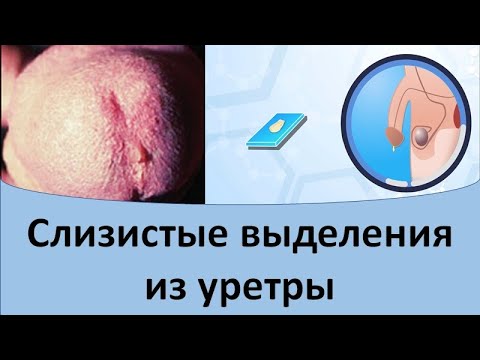 Видео: Слизистые выделения из уретры. Слизь в уретре у мужчин.