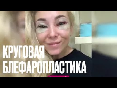 Видео: Круговая блефаропластика. Результаты до и после.