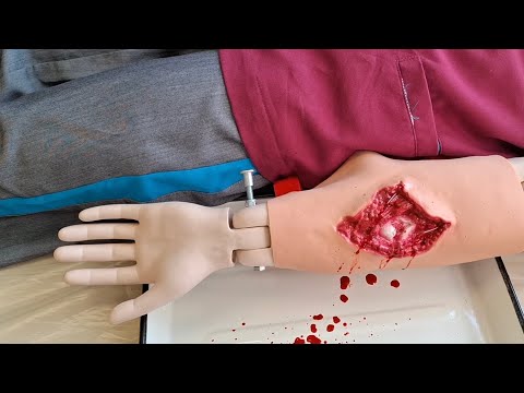 Видео: ОСТАНАВЛИВАЕМ АРТЕРИАЛЬНОЕ КРОВОТЕЧЕНИЕ | ЖГУТ ЭСМАРХА | НЕОТЛОЖКА