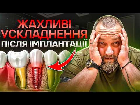 Видео: 🇺🇦 Какие могут быть осложнения после имплантации зубов