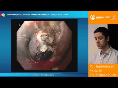 Видео: Использование нового способа эндоскопического лечения цилиндроклеточной метаплазии пищевода