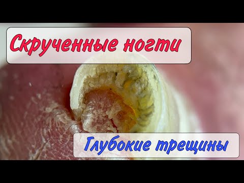 Видео: Скрученные ногти / кровавые трещины / трещины на ногах / как убрать трещины / болит палец