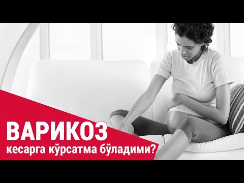 Видео: Варикоз кесарга кўрсатма бўладими