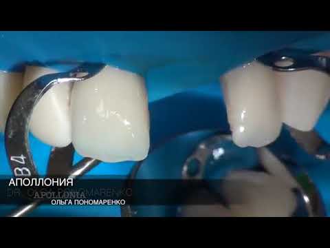 Видео: Адгезивные мостовидные конструкции. Прямой метод изготовления.