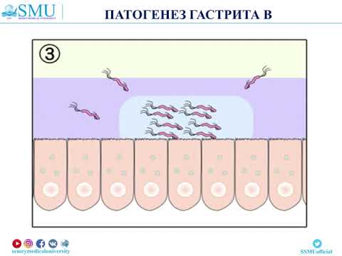 Видео: Хронический гастродуоденит
