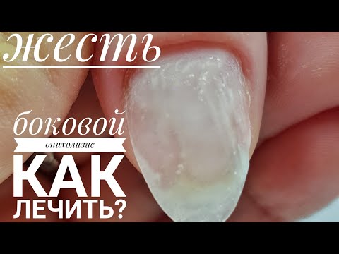 Видео: Онихолизис/Боковой онихолизис/Травматическое отслоение ногтей/Как лечить онихолизис/Шулунова Дарья