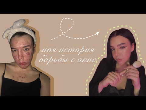 Видео: Моя история борьбы с акне.
