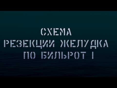 Видео: Схема резекции желудка по Бильрот I