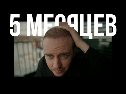Видео: 5 МЕСЯЦ после ВТОРОЙ ПЕРЕСАДКИ ВОЛОС