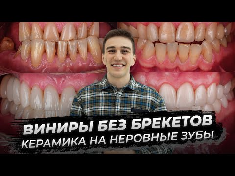 Видео: Виниры без брекетов: керамика на неровные зубы