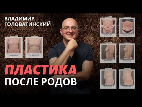 Видео: Пластика после родов. Владимир Головатинский