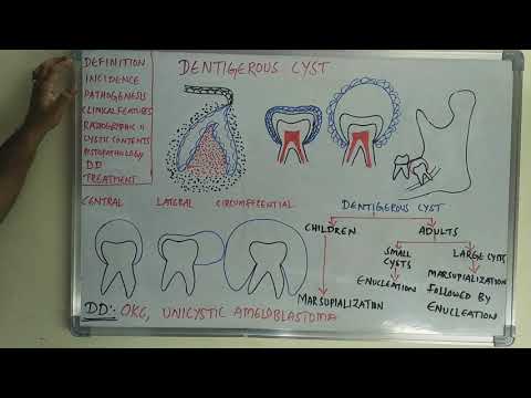 Видео: Одонтогенная киста