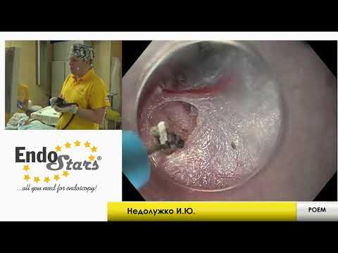 Видео: Ахалазия кардии, клинический случай №6, МКНЦ 23.01.19