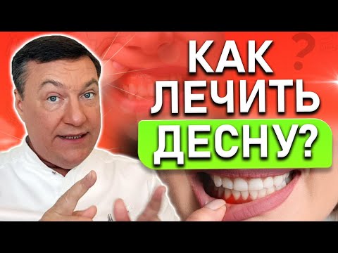 Видео: Как лечить ВОСПАЛЕНИЕ десны в домашних условиях? Гингивит и пародонтит.