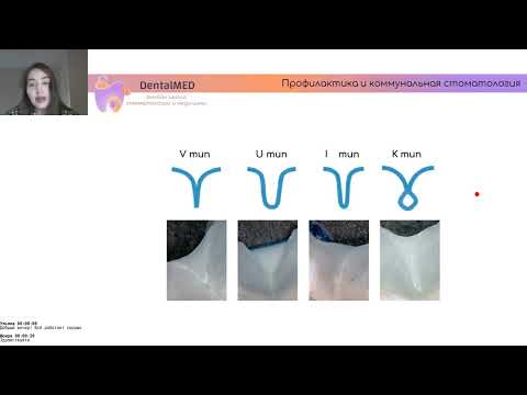 Видео: Герметизация фиссур | Профилактика и коммунальная стоматология. DentalMED