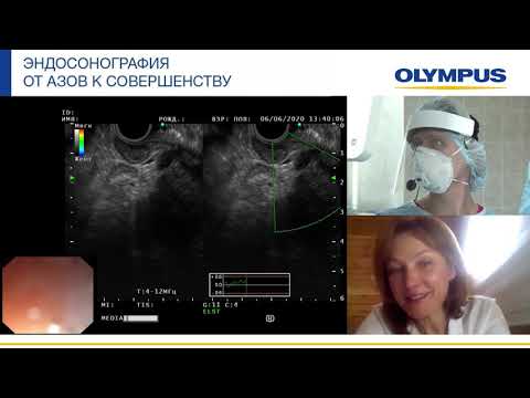 Видео: ЭУС-ТИП с целью дифференциальной диагностики патологии поджелудочной железы. Е. Н. Солодинина