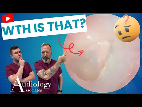 Видео: ЧТО мы только что вытащили из этого уха?! - EP1098