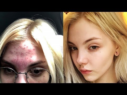 Видео: Как избавиться от прыщей