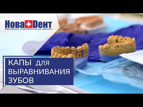 Видео: Капы для зубов. 🌞 Исправление прикуса с помощью капы для зубов. НоваДент. 12+