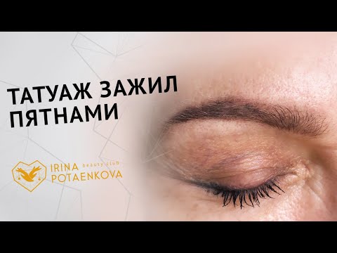 Видео: Почему татуаж бровей зажил пятнами? Как исправить?