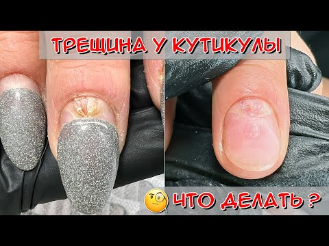 Видео: Трещина у кутикулы / Онихорексис - трещина на ногте