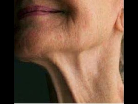 Видео: Морщины на шее. Упражнения для подтяжки и уменьшения морщин.