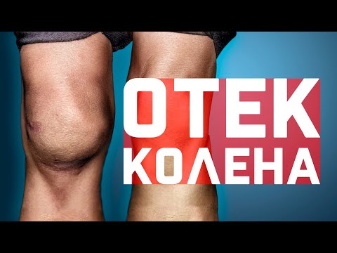 Видео: Упражнения от отёка коленного сустава и тейпирование от отеков колена.