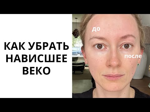 Видео: Как убрать нависшее веко и раскрыть глаза